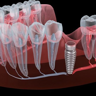 Illustration of dental implant placed in gum tissue