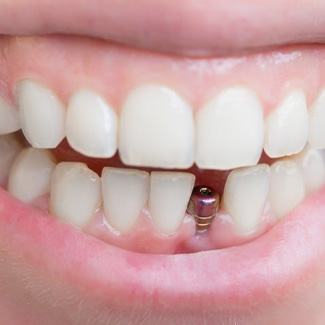 Smile with dental implant