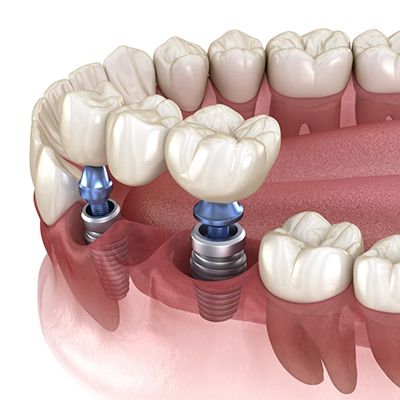 Illustration of dental bridge being attached to dental implants