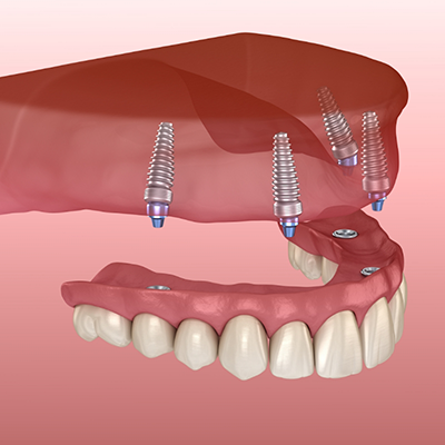 Illustration of denture being attached to dental implants