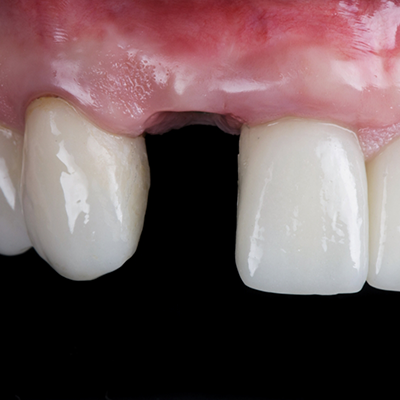 Close-up of gap between teeth