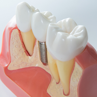 Model of a single dental implant