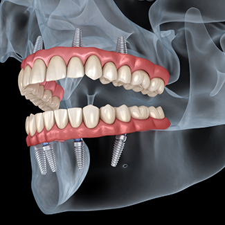 Illustration of dentures attached to dental implants