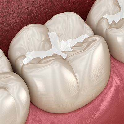 Illustration of teeth with tooth colored fillings
