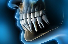 X-ray of a patient with a single dental implant 