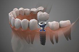 single dental implant with a crown on top 