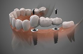 two dental implants holding a dental bridge in place