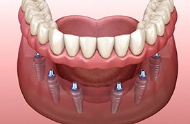 six dental implants holding a full denture in place 