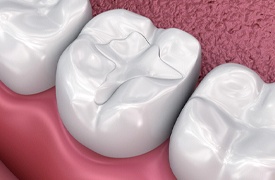 dental restoration illustration