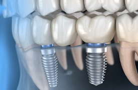 implant-supported bridge illustration 