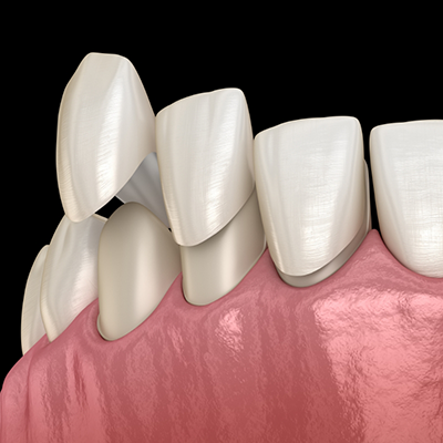 Illustration of veneers in River Ridge being attached to teeth