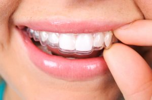 Clear braces in New Orleans are removable