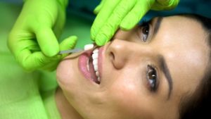 woman with veneers