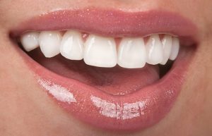 Closeup of flawless smile after cosmetic dental treatments near Metairie 