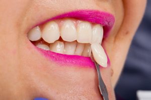 Woman at dentist getting temporary veneers