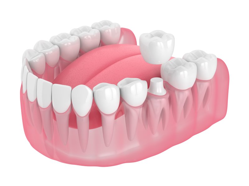 example of dental crown