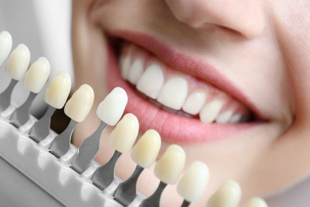 Veneers being matched to patient’s teeth.