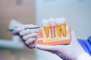 Hands in white gloves holding model dental implant