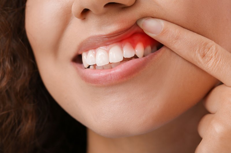 A closeup of a woman’s inflamed gum tissues